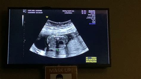 Baby Oliver Anatomy Scan Youtube