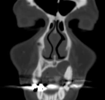 Ameloblastoma | Radiology Reference Article | Radiopaedia.org