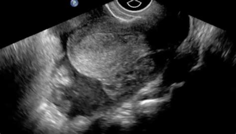 Ruptured Ectopic Pregnancy Jetem