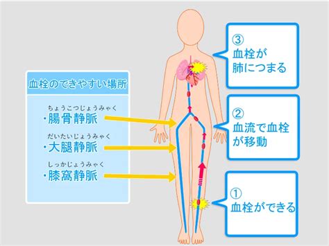 肺塞栓症の前兆や症状｜千種区本山駅の内科・循環器内科いのまたcl