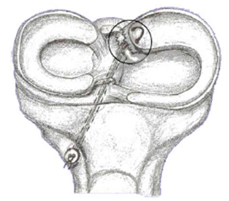 Meniscus root tears - a devastating injury - Dr. Bu Balalla