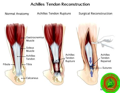 Achilles Tendon Rupture Defination Causes Symptoms Diagnosis Treatment Rx Harun