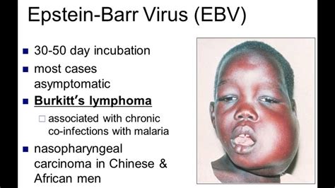 Burkitt Lymphoma YouTube