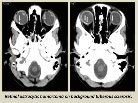 Presentation1 Radiological Imaging Of Tuberous Sclerosis