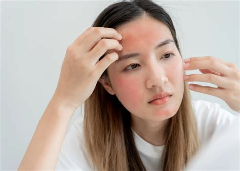 What You Should Know About Heat Rash In Malaysias Hot And Humid Weather