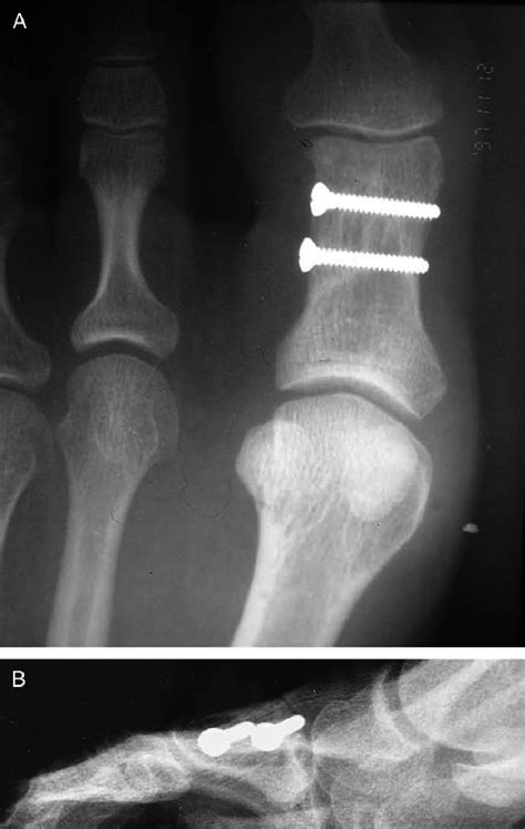 Postoperative Weight Bearing Radiographs 1 Year After The Operation