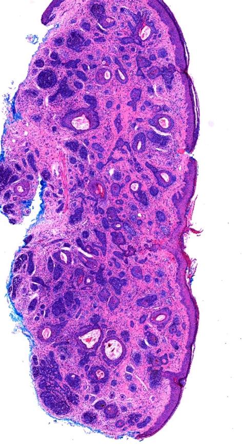 A Polypoid Cervical Neuroendocrine Carcinoma With Tumor Heterogeneity