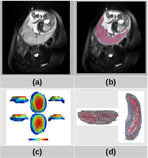 In Vivo Placental Mri Shape And Textural Features Predict Fetal Growth