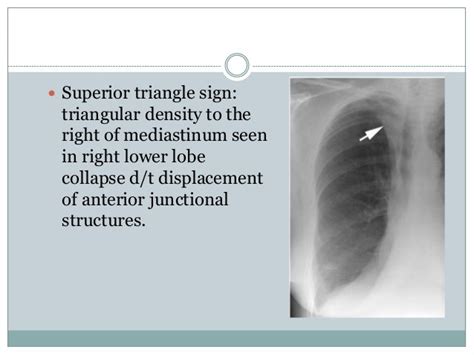 Chest Radiography Collapse