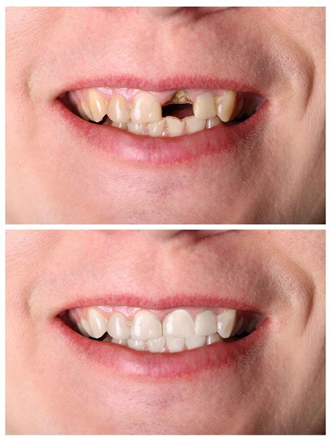 Dental Implants And Tooth Removal Meadowmont Dentistry