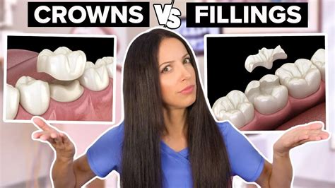 Dental Crowns Vs Dental Fillings Whats The Difference Youtube