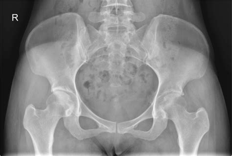 Normal Pelvis X Ray