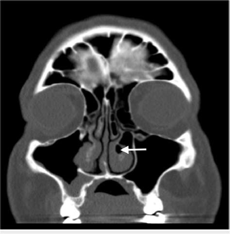 Ct Image Of Patient 2 Coronal View Coronal View Shows Cb Of Both