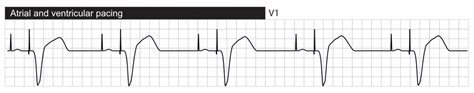 Interpretation Of Pacemaker Ecg Cardiovascular Education