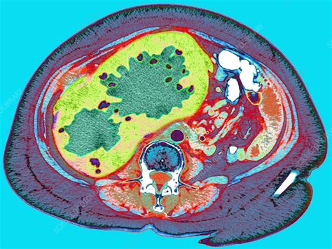 Liver cancer, CT scan - Stock Image - M134/0516 - Science Photo Library