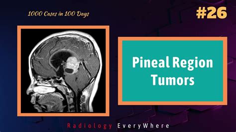 Pineal Region Tumors | Pineoblastoma | Germinoma | Pineocytoma | 1000 ...