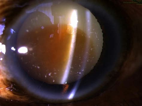 Morgagnian Cataract Tropical Ophthalmology