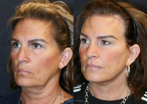 Facelift Before and After Pictures Case 9325 | Kalamazoo & Grand Rapids ...