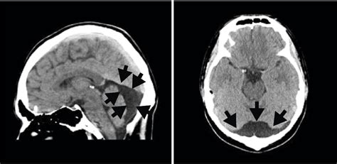 Intracranial Arachnoid Cyst