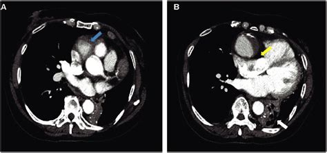 Contrast Enhanced Computed Tomography Of The Chest During The Arterial