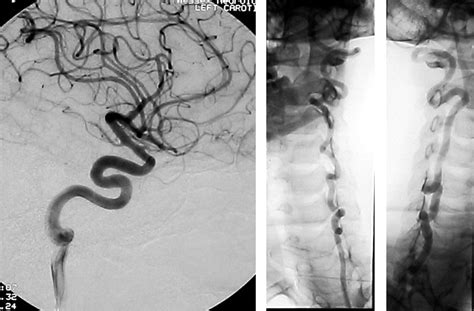 Clinical features in a family with an R460H mutation in transforming ...