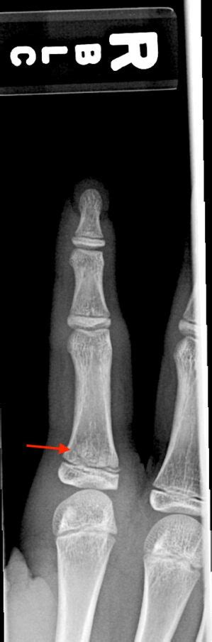 Unique Traumatic Fracture Patterns In Kids Uams Department Of Radiology