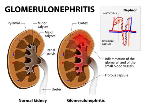 Post Streptococcal Glomerulonephritis Doctall Living