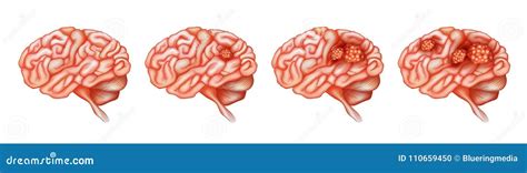 Diversas Etapas Del Cáncer En Cerebro Ilustración Del Vector