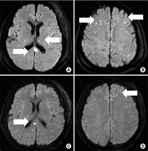 Figure 1 From Analysis Of Diffuse Axonal Injury Using Diffusion Tensor