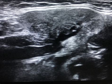 Left Submandibular Calculus Sialadenitis