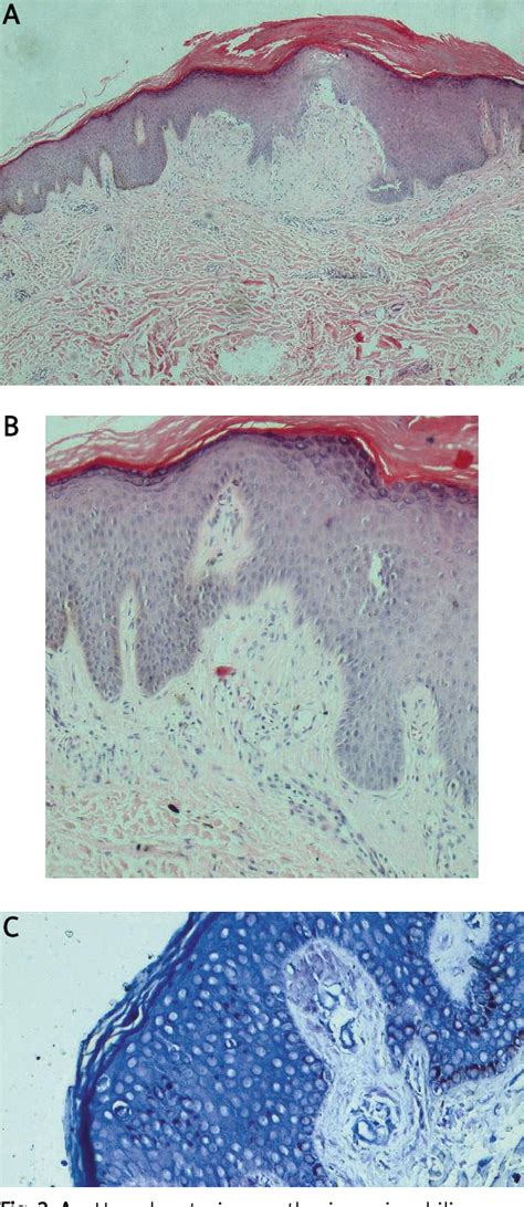 Figure From Generalized Lichen Amyloidosis And Hyperthyroidism