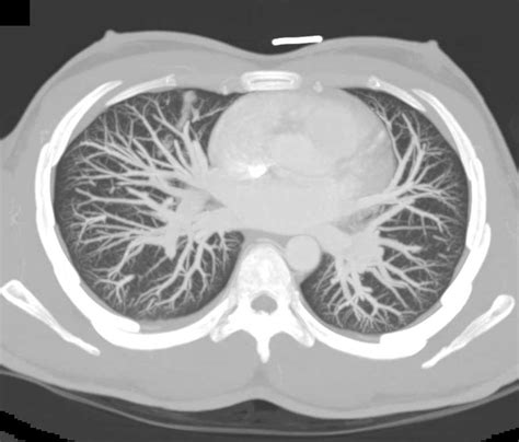 Small Right Pneumothorax Post Biopsy Chest Case Studies Ctisus Ct