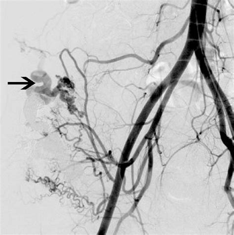 Frontal Pelvic Arteriogram After Embolization Shows Minimal Filling Of