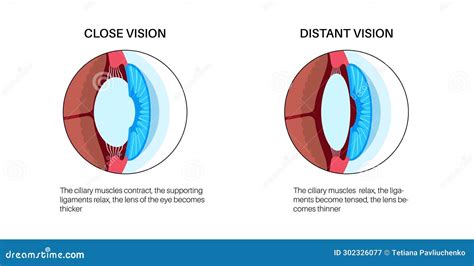 Eye accommodation poster stock vector. Illustration of relax - 302326077