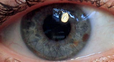 Corneal Transplant Stitches