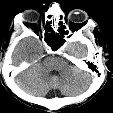 CT scan of the head without contrast. Unremarkable CT scan of the head... | Download Scientific ...