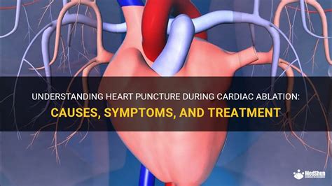 Understanding Heart Puncture During Cardiac Ablation Causes Symptoms