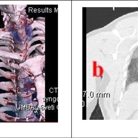 Patient 9 A 3D Computed Tomography Reconstruction Anterior View