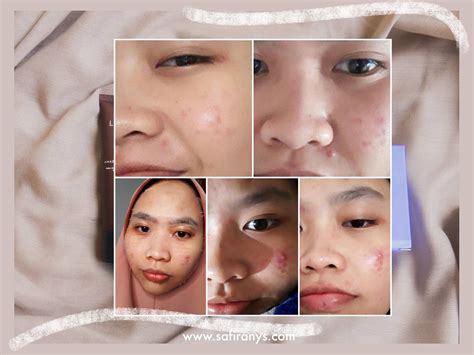 Skincare Terbaik Untuk Kulit Berminyak Dan Berjerawat Bagi Hal Baik