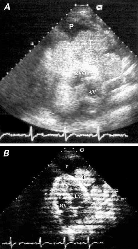 Two Dimensional Transthoracic Echocardiograms A A Parasternal