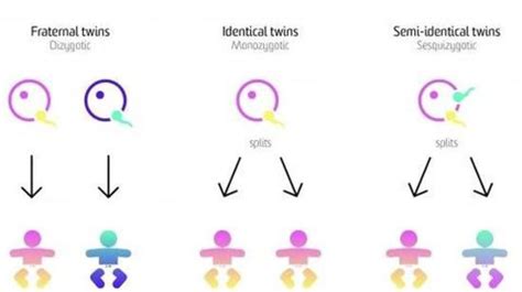 Australia Second Case Of Semi Identical Twins A Rare Phenomenon Found Newsbytes