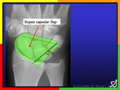 Scapholunate Ligament Repair And Dorsal Capsulodesis