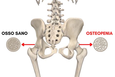 Osteopenia Una Possibile Causa Di Mal Di Schiena