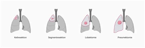 Operationsmethoden Bei Lungenkrebs DocCheck