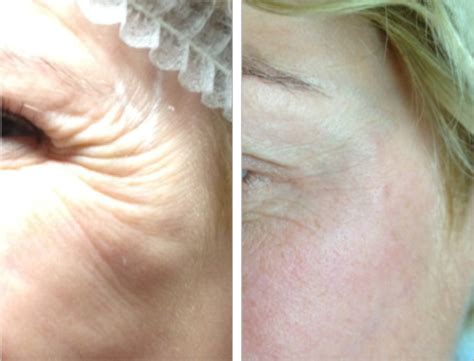 Thread Lift Treatment The Non Surgical Face Lift And Neck Lift