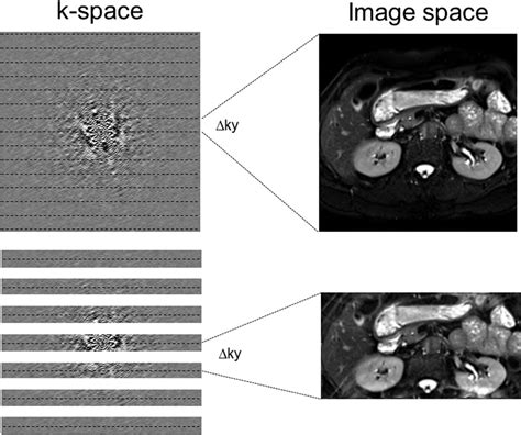 Body Mr Imaging Artifacts K Space And Solutions Radiographics