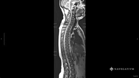 Cervical Thoracic Spine MRi by Navegatium App #Radiology #MRi | Anatomia corpo humano, Corpo ...