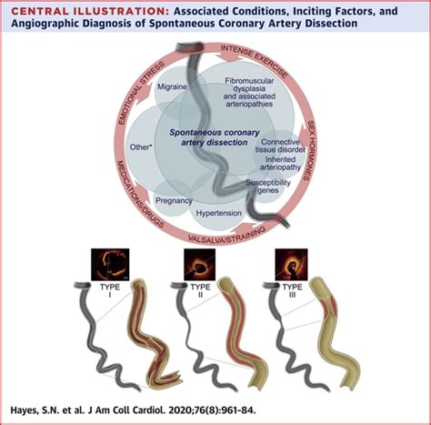 Spontaneous Coronary Artery Dissection Jacc State Of The Art Review