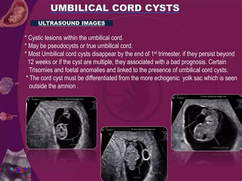 Umblical cord presentation | PPTX