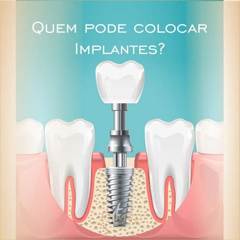 Implantes Dentários Inovarp Dra Claudia Bustamante e Dr Paulo Melo